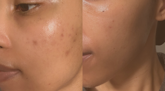 Acne heals better with GRWN Skincare's microneedle acne patch
