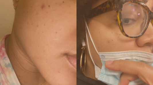 Microneedle acne patch works. The proof is in the progress pics.