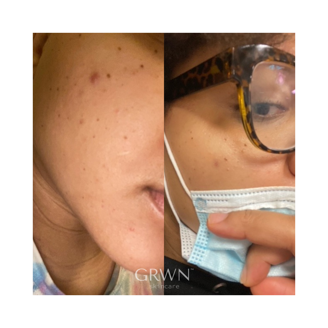 GRWN Skincare ICE ME OUT Microneedle Acne Patch Before and After 1
