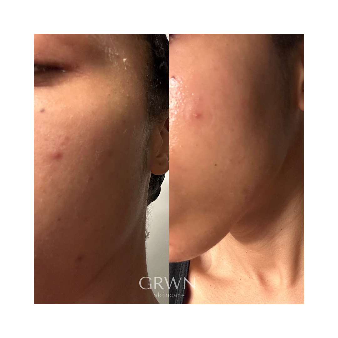 GRWN Skincare ICE ME OUT Microneedle Acne Patch Before and After 4