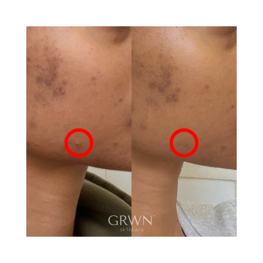 GRWN Skincare ICE ME OUT Microneedle Acne Patch Before and After 2