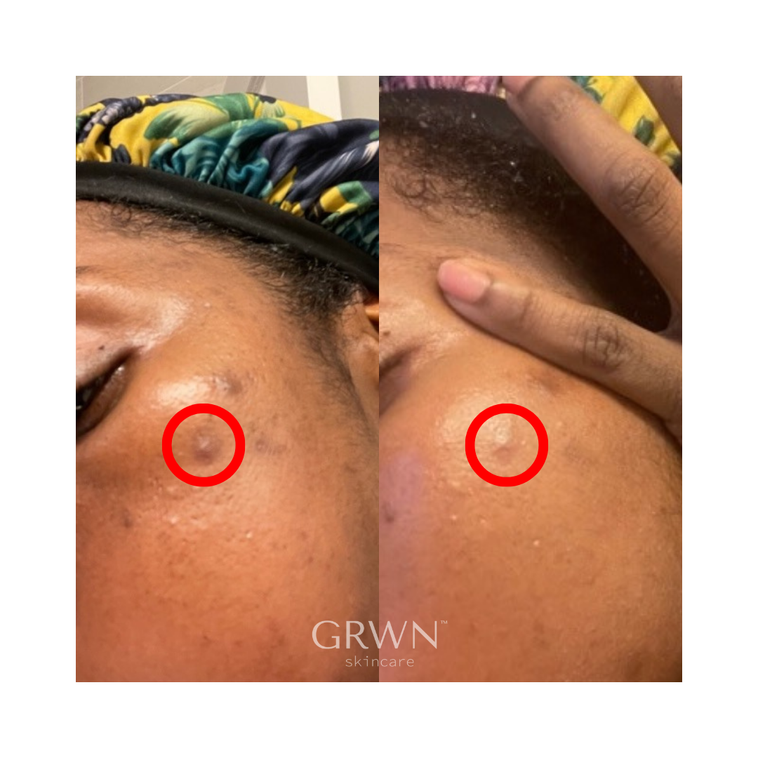 GRWN Skincare ICE ME OUT Microneedle Acne Patch Before and After 3