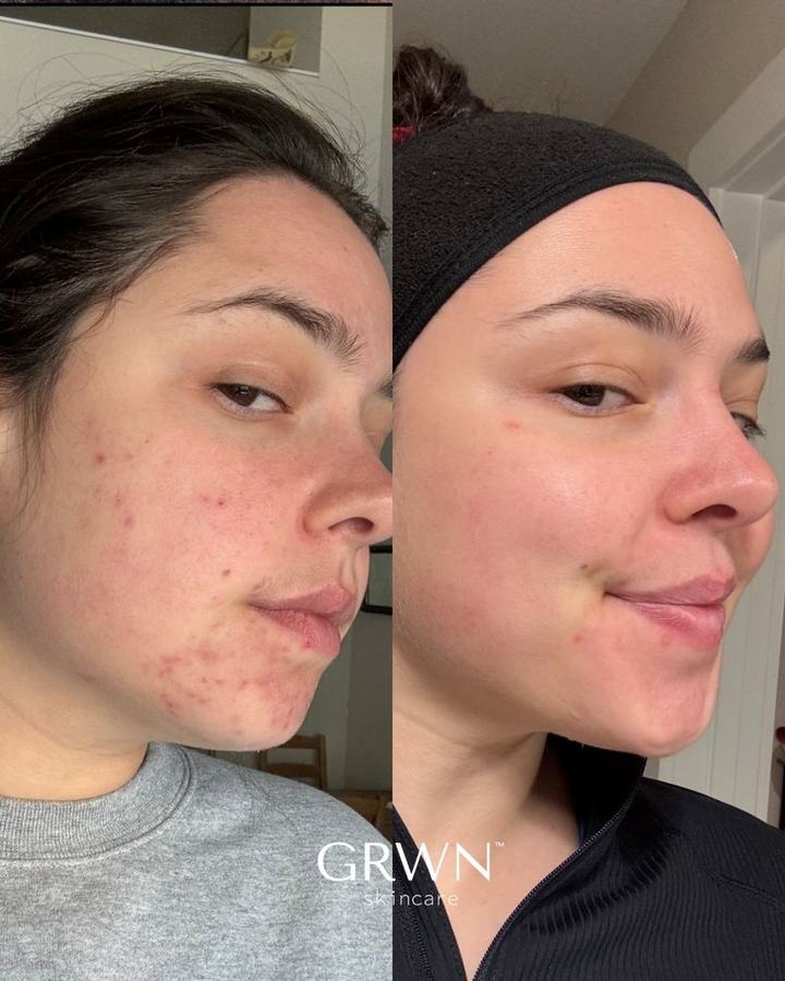 Before and after acne treatment, Washington DC esthetician