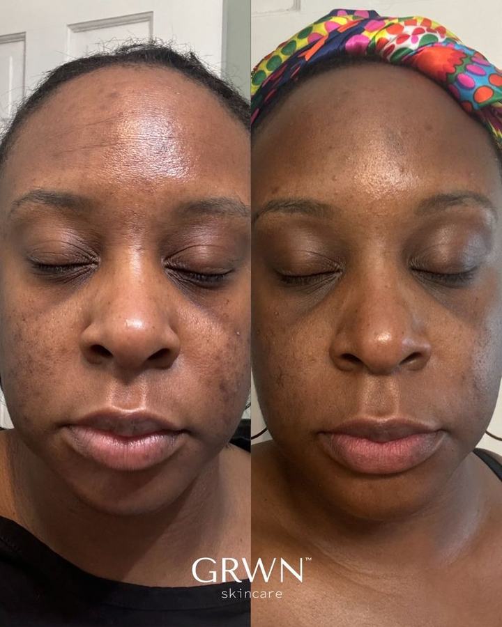 Before and after skin texture treatment, melanin-rich skin, Washington DC esthetician