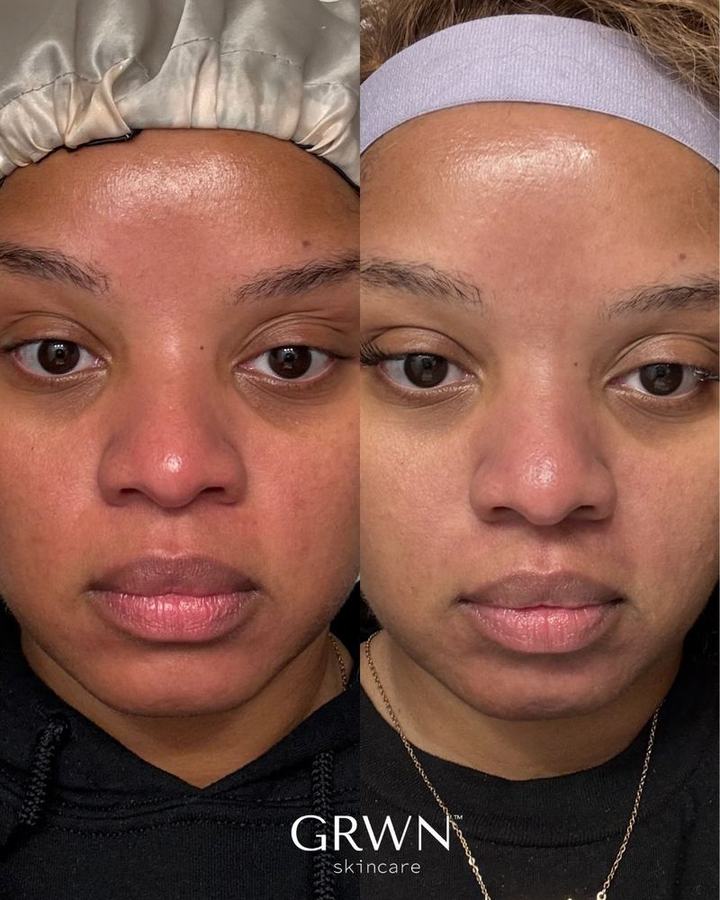 Before and after uneven skin tone treatment, melanin-rich skin, Washington DC esthetician