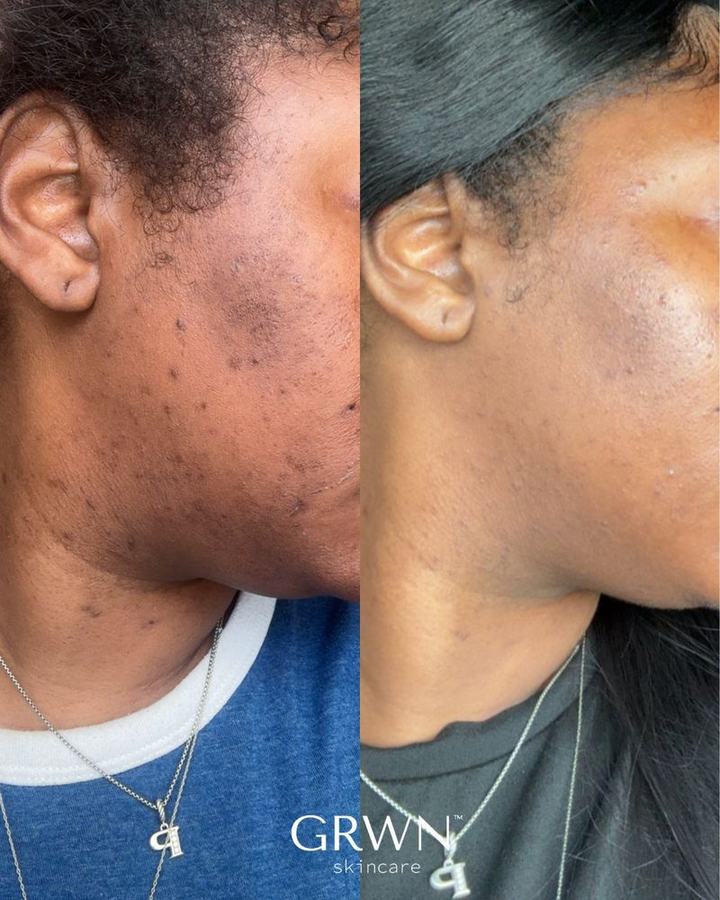 Before and after hyperpigmentation treatment, melanin-rich skin, Washington DC esthetician